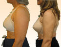 Liposuction Research